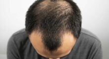 hair loss
