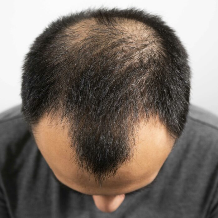 hair loss