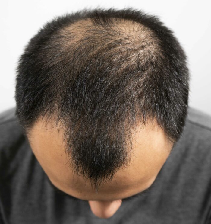hair loss