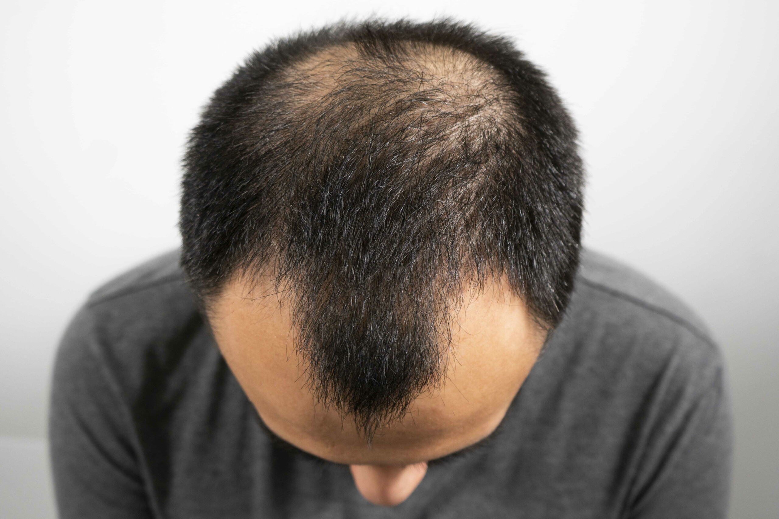 hair loss