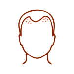 Receding Hairline Reconstruction