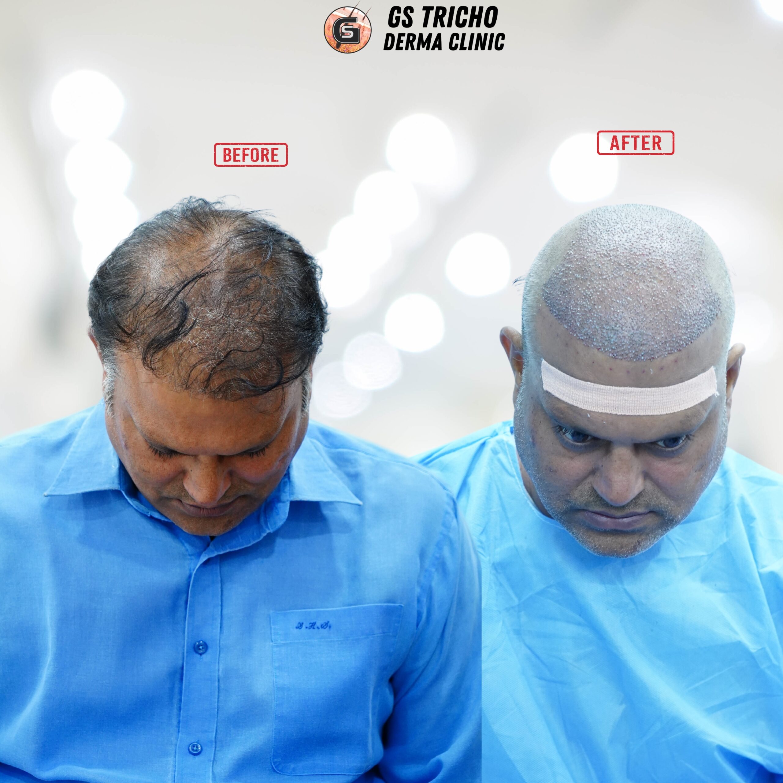 Transform your story with confidence—restore hair in scarred areas caused by a lion attack and rediscover the beauty of a full, natural look with our expert hair transplant solutions