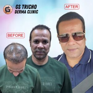 Hair restoration success with FUE transplant by Dr. G.K. Sharma