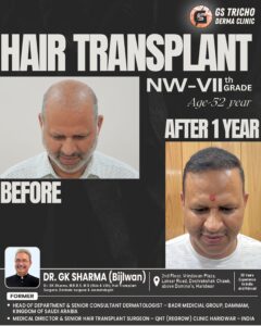 HAIR TRANSPLANT (1).jpg