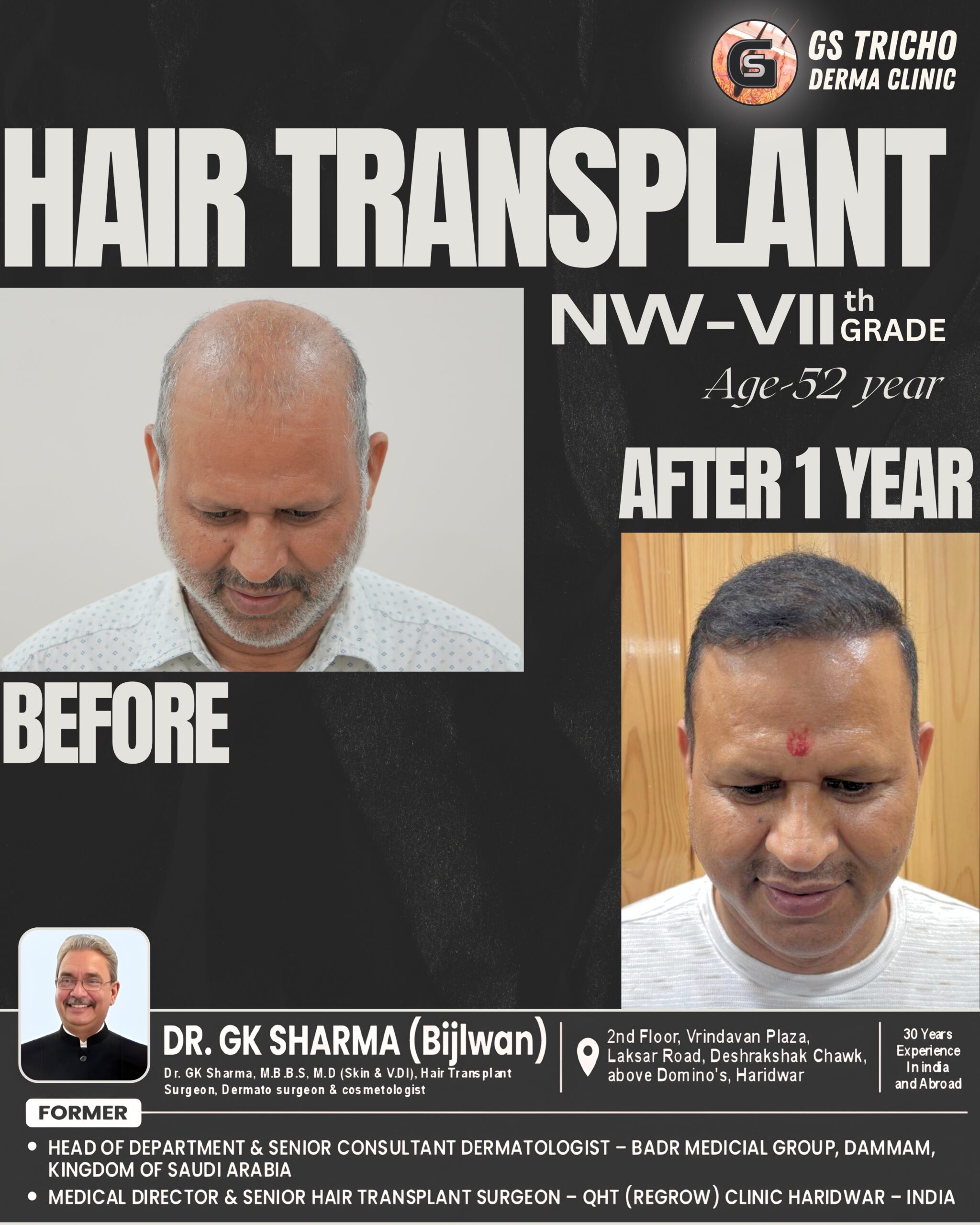 HAIR TRANSPLANT (1).jpg