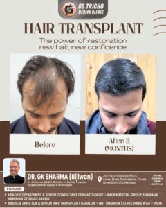HAIR TRANSPLANT.jpg