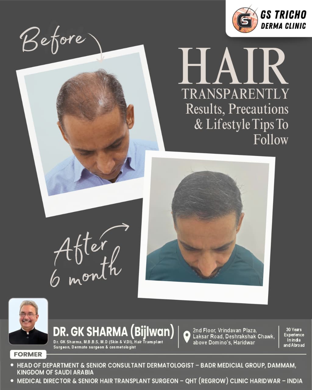 Hair transplant near me